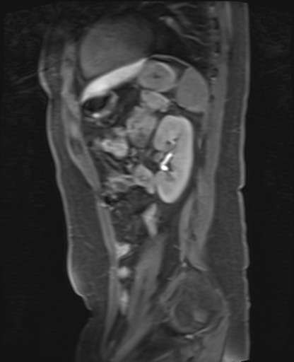 File:Normal hepatobiliary phase liver MRI (Radiopaedia 58968-66230 C 56).jpg