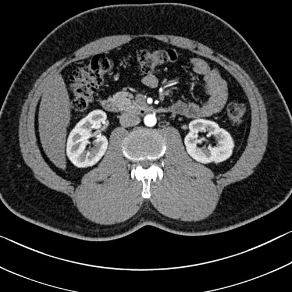 Normal kidneys on 4-phase CT study (Radiopaedia 25889-26038 B 48).jpg