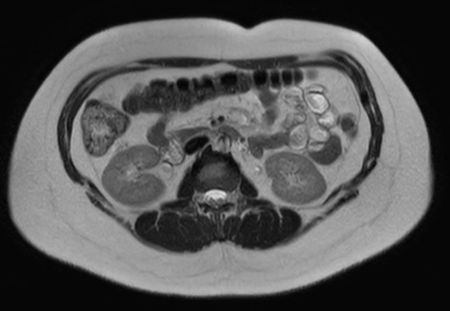 File:Normal liver MRI with Gadolinium (Radiopaedia 58913-66163 Axial T2 10).jpg