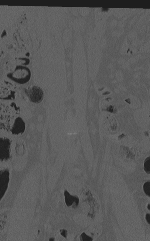 Normal lumbar spine CT (Radiopaedia 46533-50986 Coronal bone window 10).png