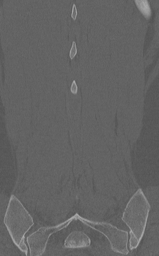 Normal lumbar spine CT (Radiopaedia 46533-50986 Coronal bone window 70).png