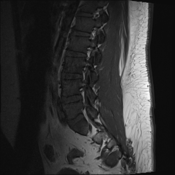 File:Normal lumbar spine MRI (Radiopaedia 47857-52609 Sagittal T1 14).jpg