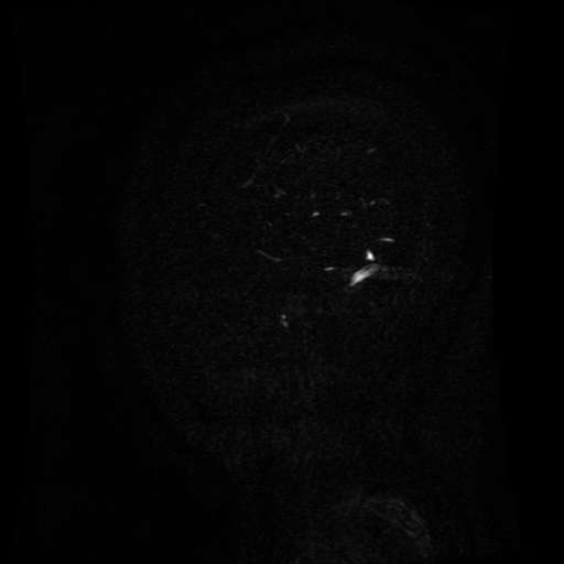 Normal noncontrast MR venography (Radiopaedia 87578-103957 A 158).jpg