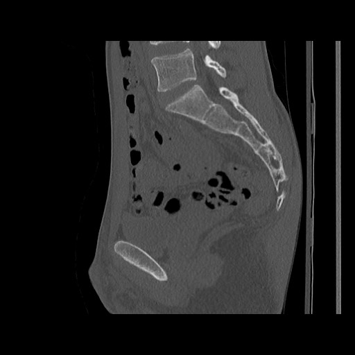 Normal pelvis (Radiopaedia 51473-57238 Sagittal bone window 81).jpg