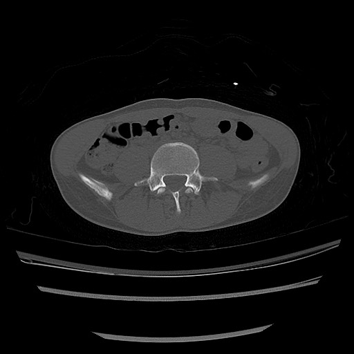 Normal pelvis CT (Radiopaedia 51471-57236 Axial bone window 5).jpg