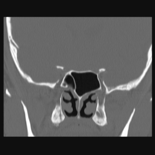 Normal sinus CT (annotated) (Radiopaedia 78917-91810 Coronal bone window 40).jpg