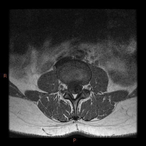 File:Normal spine MRI (Radiopaedia 77323-89408 Axial T1 7).jpg