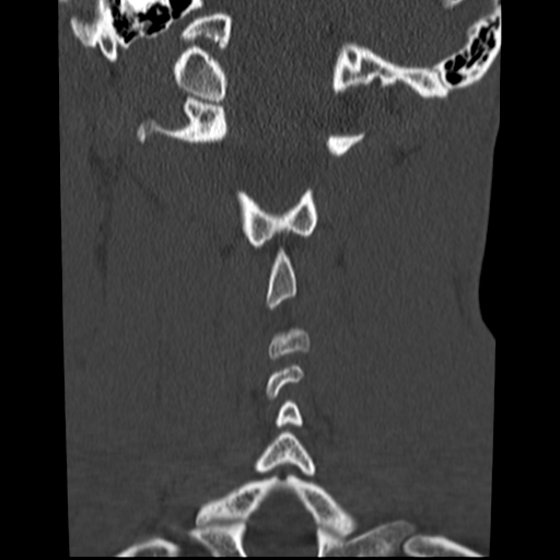 File:Normal trauma cervical spine (Radiopaedia 41017-43760 Coronal bone window 30).png