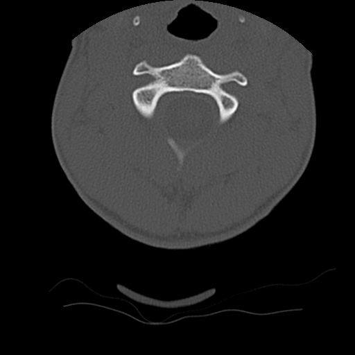 Normal trauma spine imaging (age 16) (Radiopaedia 45335-49358 Axial bone window 20).jpg