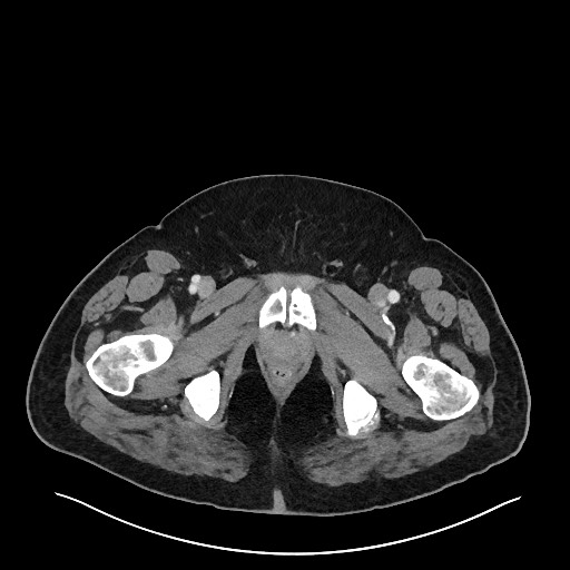 Obstructing sigmoid adenocarcinoma (Radiopaedia 58465-65619 A 166).jpg