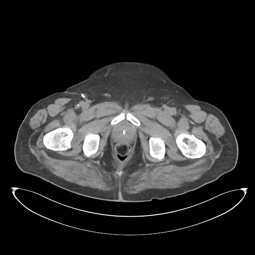 File:Obstructive pyelonephritis (Radiopaedia 46411-50844 Axial non-contrast 81).png