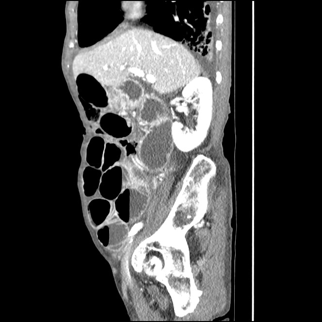 Obturator hernia causing small bowel obstruction (Radiopaedia 65522-74612 C 68).jpg