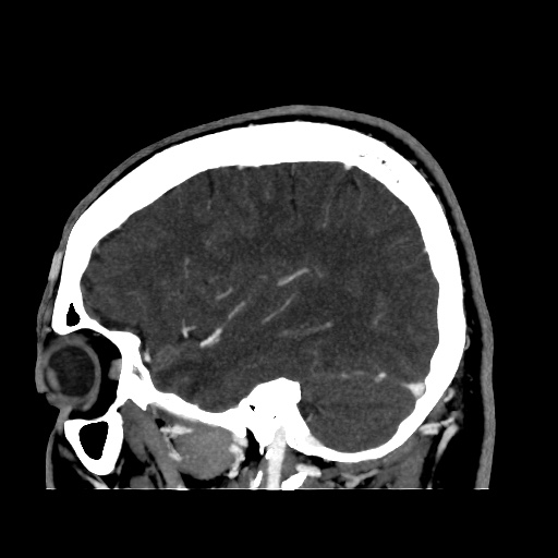 Occipital extradural hematoma simulating venous sinus thrombosis (Radiopaedia 46514-50964 D 21).jpg