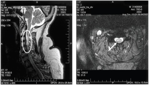 a,b)MRI of cervical spinal cord of individual with bilateral upper extremity paralysis and respiratory failure from West Nile poliomyelitis