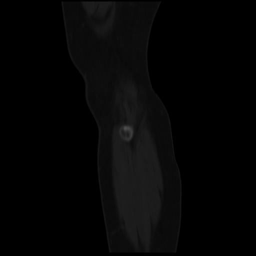 File:ACL avulsion fracture (Radiopaedia 33833-34994 Sagittal bone window 2).jpg