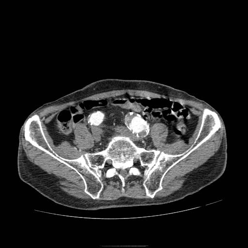 Abdominal aortic aneurysm (Radiopaedia 13341-13340 Axial C+ arterial phase 175).jpg