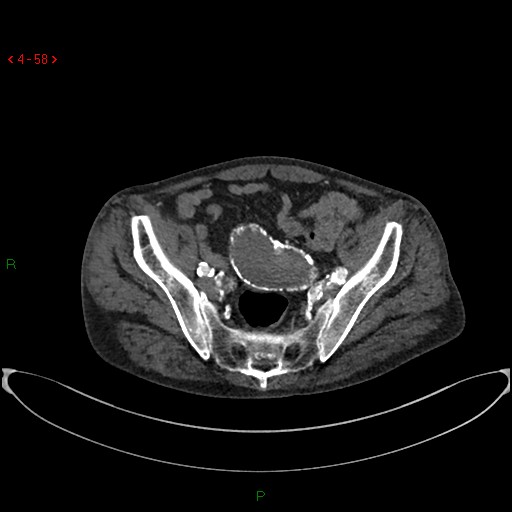 File:Abdominal aortic aneurysm (Radiopaedia 16155-15834 Axial C+ arterial phase 38).jpg