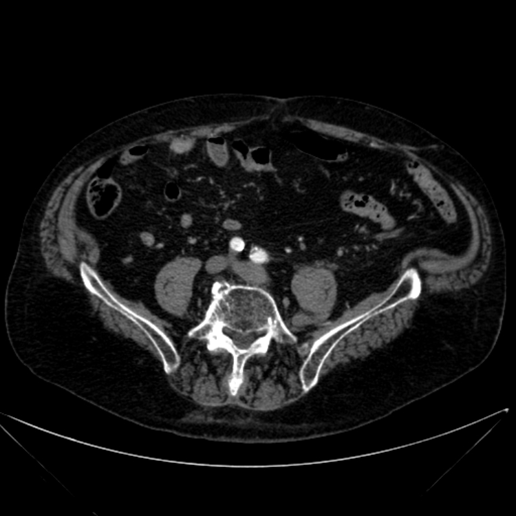 Abdominal aortic aneurysm (Radiopaedia 25855-26001 Axial C+ arterial phase 92).jpg