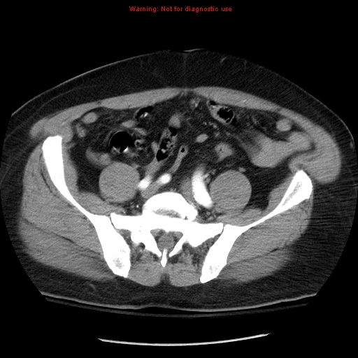 Abdominal aortic aneurysm (Radiopaedia 8190-9038 Axial C+ arterial phase 60).jpg
