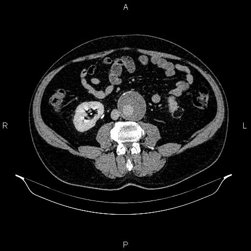 Abdominal aortic aneurysm (Radiopaedia 83094-97462 Axial renal excretory phase 61).jpg