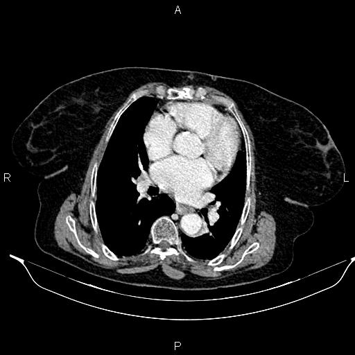 File:Abdominal aortic aneurysm (Radiopaedia 85063-100606 Axial C+ portal venous phase 19).jpg