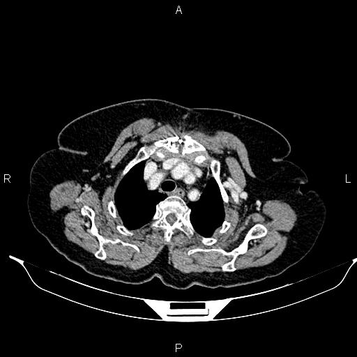 File:Abdominal aortic aneurysm (Radiopaedia 85063-100606 Axial C+ portal venous phase 9).jpg