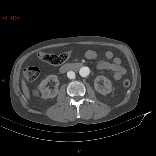 Abdominal aortic aneurysm rupture with aortocaval fistula (Radiopaedia 14897-14841 Axial C+ arterial phase 110).jpg