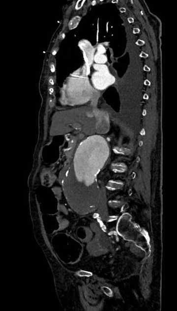 Abdominal aortic aneurysm with thrombus fissuration (Radiopaedia 73192-83919 Sagittal C+ arterial phase 83).jpg