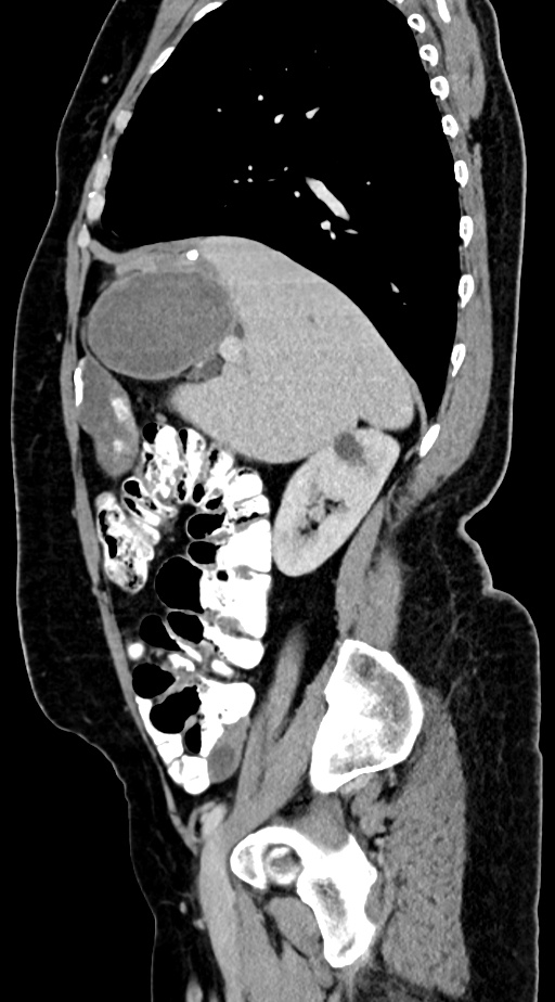 Abdominal hydatid disease (Radiopaedia 68223-77737 Sagittal C+ portal venous phase 50).jpg