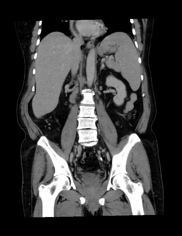 Abdominal lymphoma - with sandwich sign (Radiopaedia 53486-59492 C+ portal venous phase 24).jpg