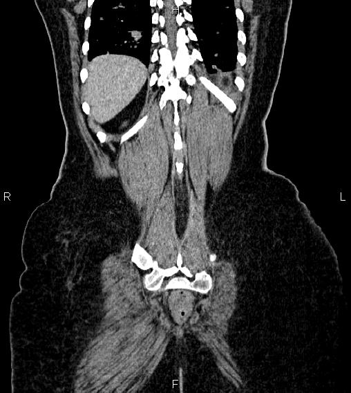 Abdominal lymphoma with sandwich sign (Radiopaedia 84378-99704 Coronal C+ portal venous phase 62).jpg