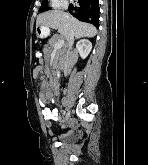 Abdominal lymphoma with sandwich sign (Radiopaedia 84378-99704 Sagittal C+ portal venous phase 34).jpg