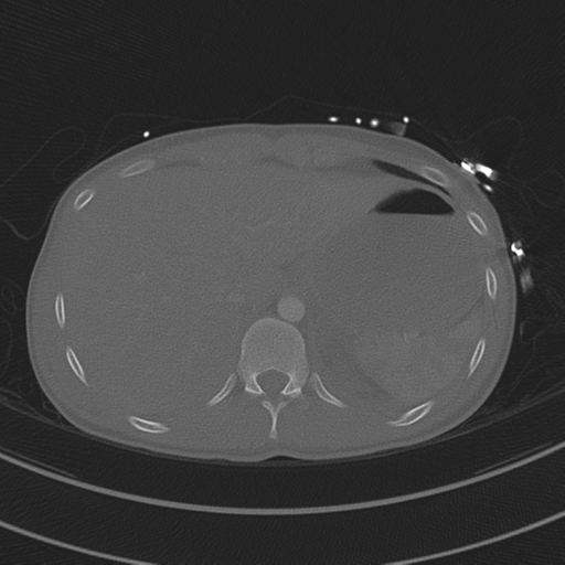 File:Abdominal multi-trauma - devascularised kidney and liver, spleen and pancreatic lacerations (Radiopaedia 34984-36486 I 79).png