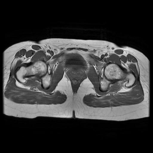 File:Abdominal wall endometriosis (Radiopaedia 83702-98847 Axial T1 16).jpg