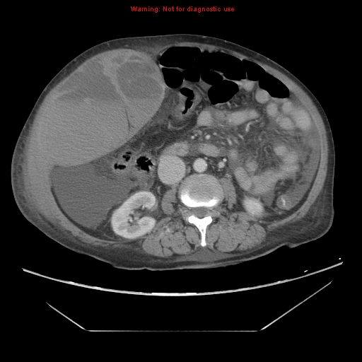 File:Abdominal wall hematoma (Radiopaedia 9427-10112 Axial C+ portal venous phase 51).jpg