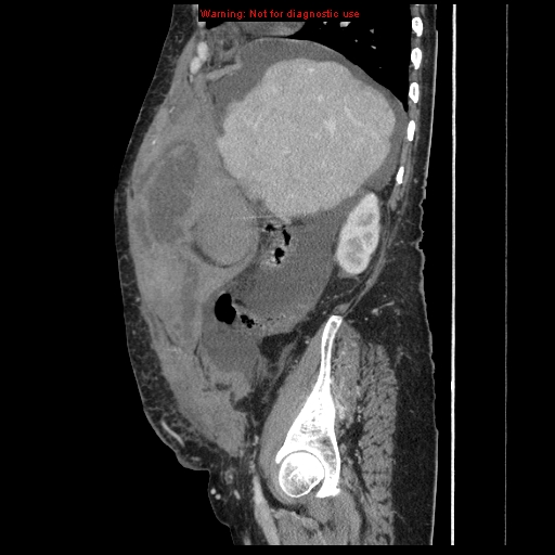 File:Abdominal wall hematoma (Radiopaedia 9427-10112 Sagittal C+ portal venous phase 79).jpg