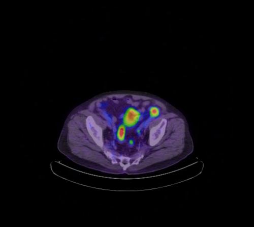File:Abdominal wall metastasis from colorectal carcinoma (Radiopaedia 31016-31719 Axial 34).jpg