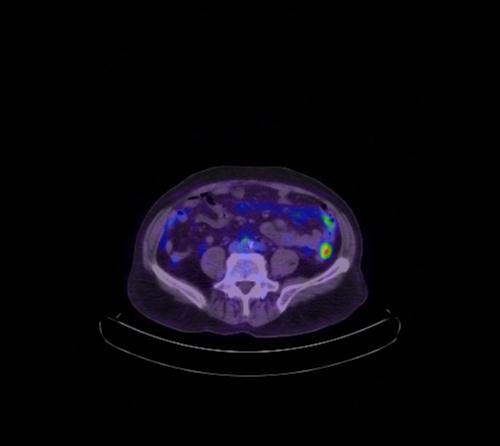 Abdominal wall metastasis from colorectal carcinoma (Radiopaedia 31016-31719 Axial 50).jpg