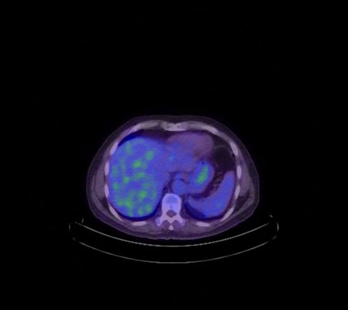 Abdominal wall metastasis from colorectal carcinoma (Radiopaedia 31016-31719 Axial 92).jpg