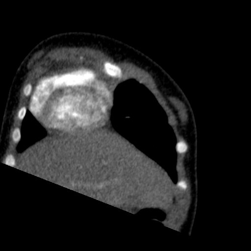 File:Aberrant left pulmonary artery (pulmonary sling) (Radiopaedia 42323-45435 Coronal C+ CTPA 23).jpg