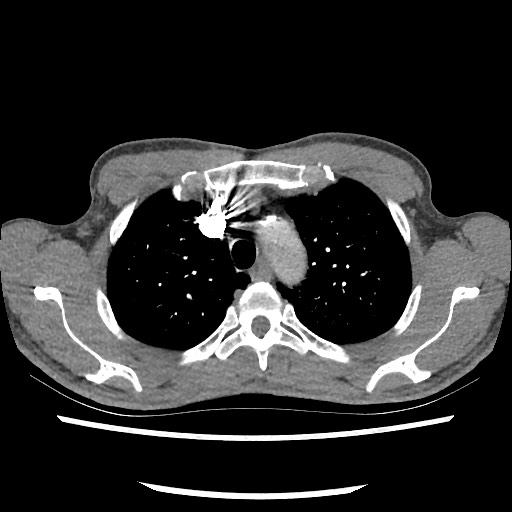 Accessory left horizontal fissure with lingular pneumonia (Radiopaedia 53763-59843 Axial C+ CTPA 24).jpg