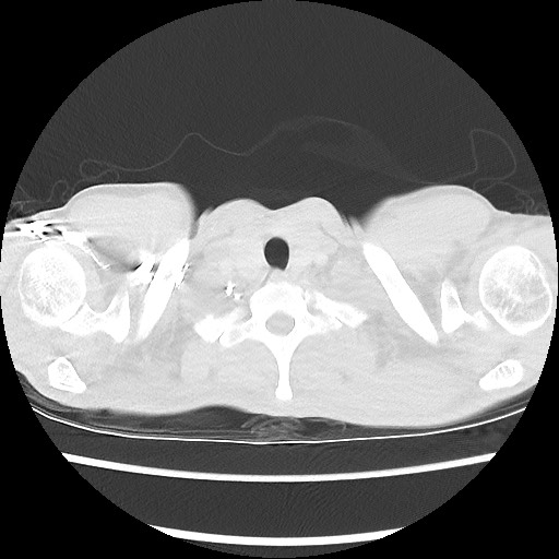 Accessory left horizontal fissure with lingular pneumonia (Radiopaedia 53763-59843 Axial lung window 3).jpg