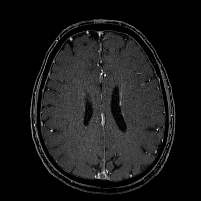 Accessory middle cerebral artery (Radiopaedia 73114-83828 Axial MRA 141).jpg