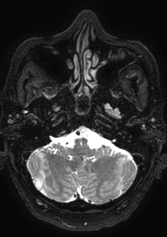 Accessory middle cerebral artery (Radiopaedia 73114-83828 Axial T2 181).jpg