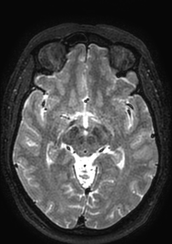 Accessory middle cerebral artery (Radiopaedia 73114-83828 Axial T2 98).jpg
