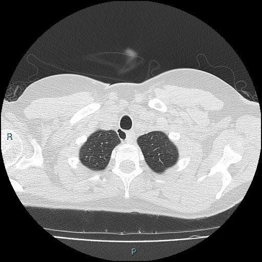 File:Accidental foreign body aspiration (seamstress needle) (Radiopaedia 77740-89983 Axial lung window 7).jpg