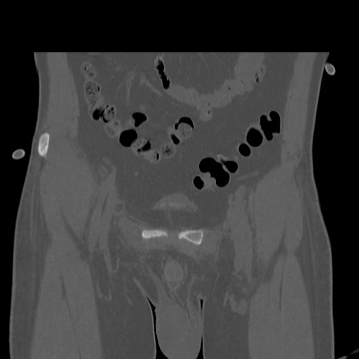 Acetabular and ilial fractures (Radiopaedia 59084-66378 Coronal bone window 9).jpg