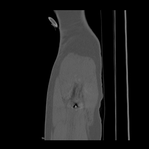 Acetabular and ilial fractures (Radiopaedia 59084-66378 Sagittal bone window 100).jpg