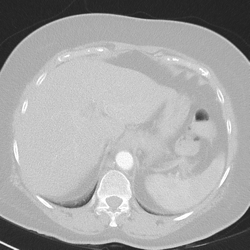 File:Achalasia (Radiopaedia 47147-51685 Axial lung window 45).png