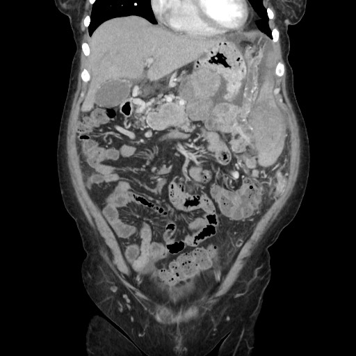 File:Acinar cell carcinoma of the pancreas (Radiopaedia 75442-86669 Coronal C+ portal venous phase 39).jpg